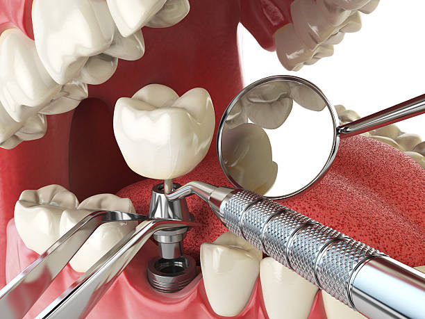 Best Emergency Dentist for Lost Fillings or Crowns in Pioneer, OH